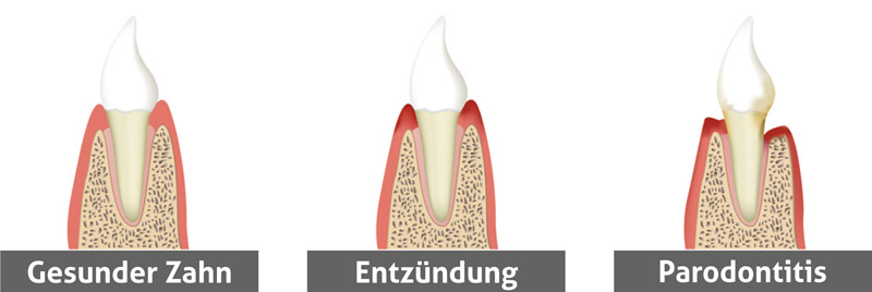 Parodontitis-Behandlung Neustadt/Aisch